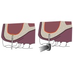 Kit de elevação dos seios Sinkit3 - Image 2
