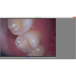 Câmara intraoral MoniCam PX-200 - Image 2